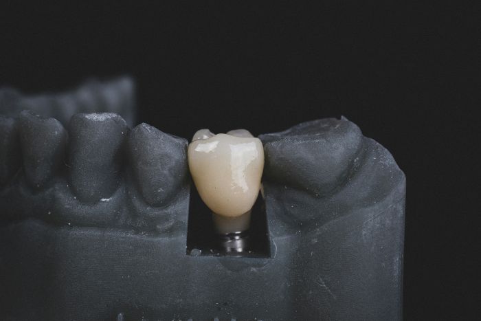 Image of how dental implants work.