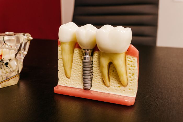3D illustration of a dental implant.